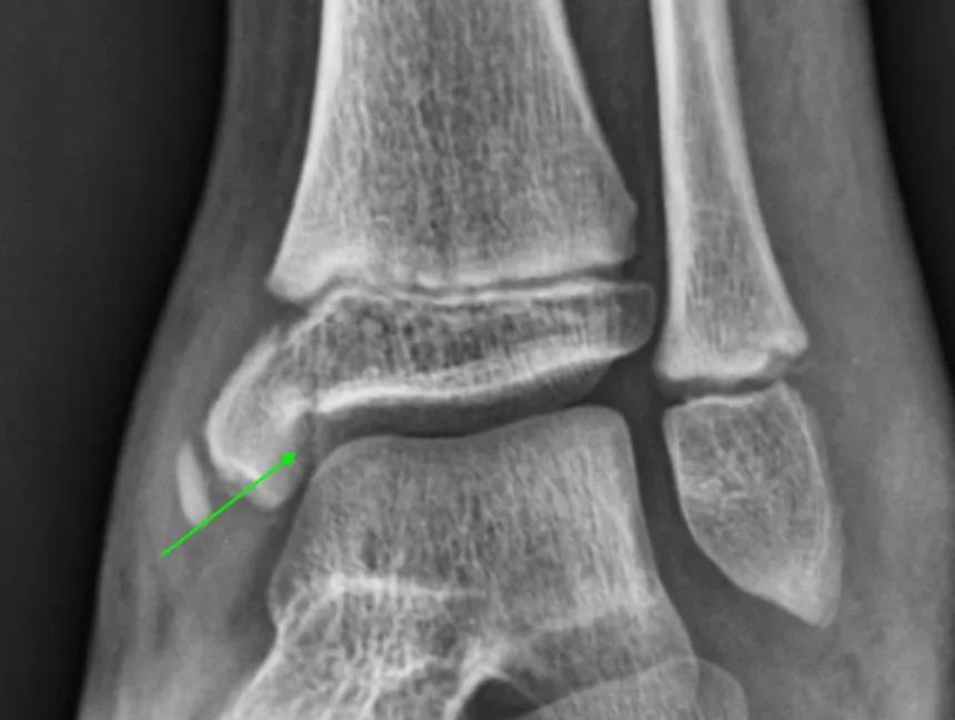 Growth Plate Injuries in Children