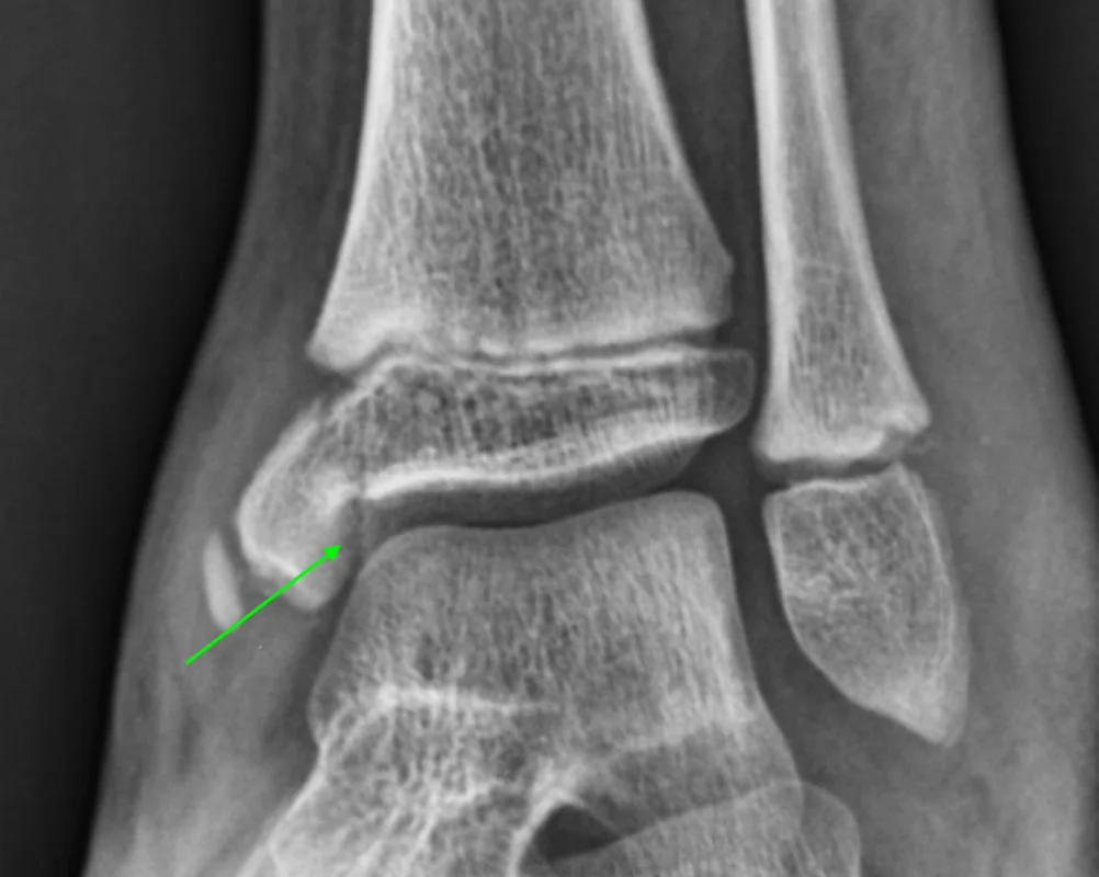 Growth Plate Injuries in Children